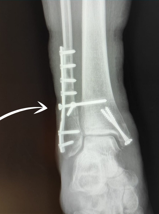 репозиуия переломов